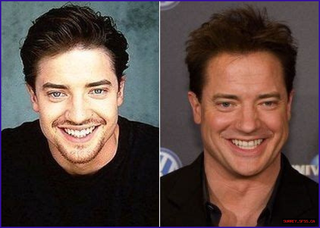 Brendan Fraser Plastic Surgery Before and After