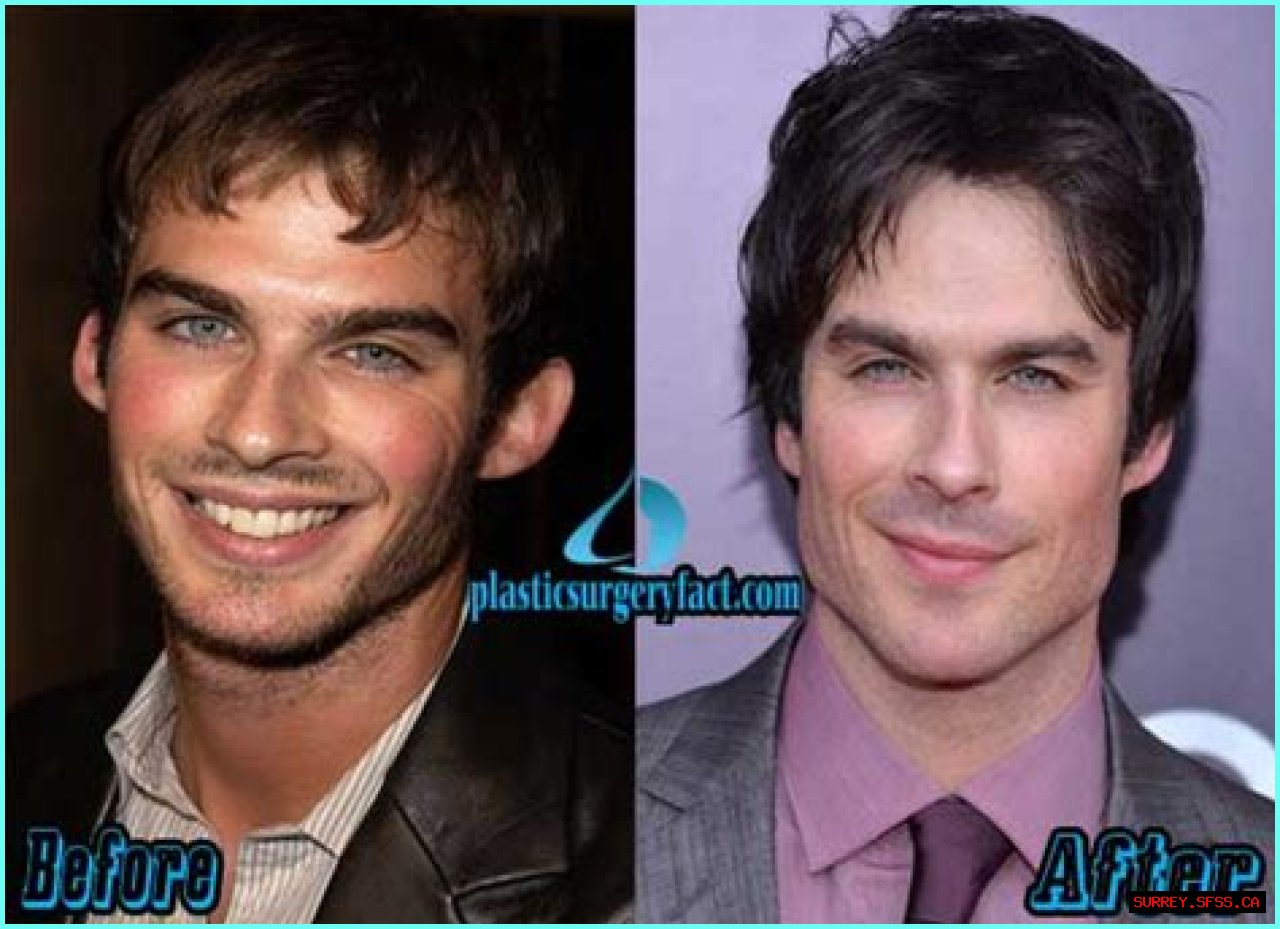 Ian Somerhalder Plastic Surgery Before and After