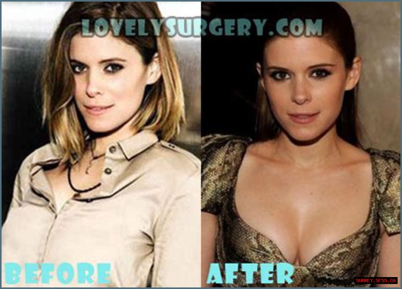 Kate Mara Plastic Surgery Before and After